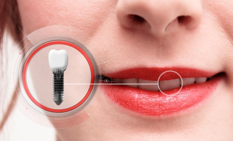 Co to jest implant zęba ?